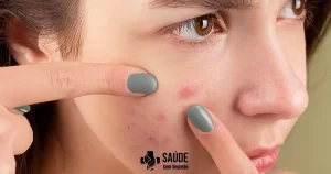 acnes e espinhas - image - blog saúde sem segredo